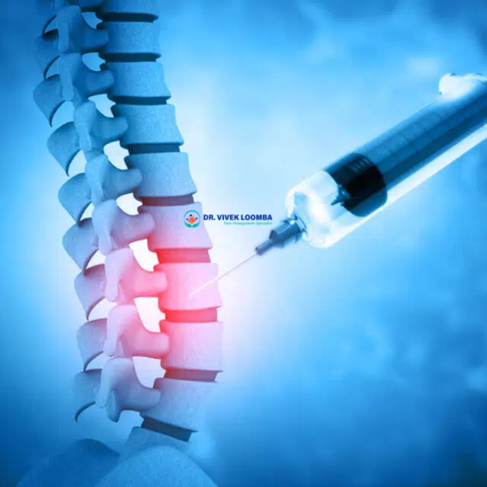 Steroids for Back Pain Effective Relief or Temporary Fix A Comprehensive Guide